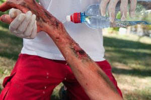 Water being poured on a man with third degree burns on his arm