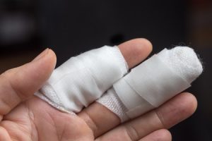 Close up of two crushed fingers in a cast after they were caught in a door