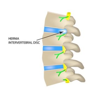 Diagram showing the hernia intervertebral disc