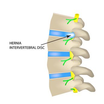Herniated Disc Settlement Amounts - How Much Compensation Can You Expect?