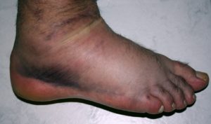 An injured ankle