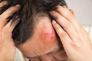 Concussion injury claim claims