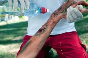 Person applying cold water to a chemical burn injury victim's hand