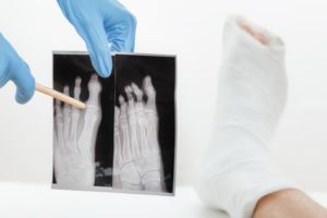 Fractured Metatarsal At Work personal injury claims payouts for a fractured metatarsal
