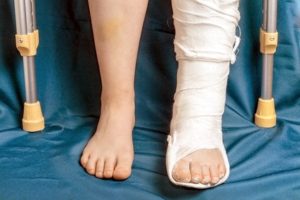 broken leg compensation payouts