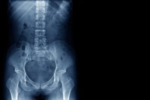 Pelvis injury personal injury claims payouts for a pelvis injury