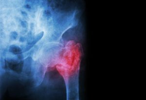 Compensation For A Broken Pelvis personal injury claims payouts for a broken pelvis