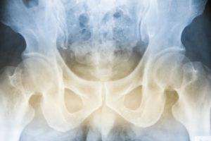 Compensation for a broken hip Personal Injury Claims Payouts for a Hip Injury