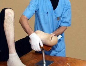 Lower leg amputation compensation personal injury claims payouts for a lower leg amputation