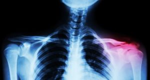 Broken collarbone compensation personal injury claims payouts for a fractured collarbone.
