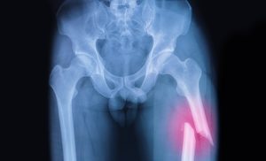 Femur fracture compensation personal injury claims payouts for a femur fracture