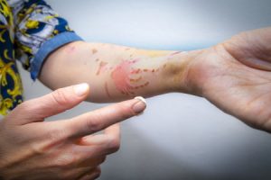 A person rubbing cream on skin that has peeled off due to an acid attack