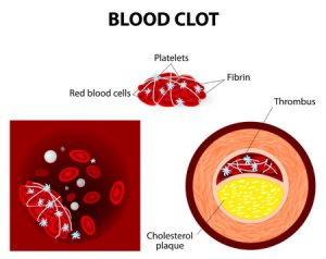 Blood clot compensation claims guide blood clot claim