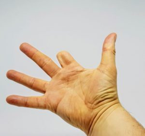 An image of a man with an amputated finger making a finger amputation claim