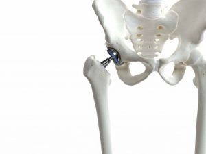 Negligent hip replacement injury compensation claims guide medical negligence payouts for a hip replacement payouts for hip replacements Hip replacement compensation* Hip replacement compensation payouts Hip replacement claims