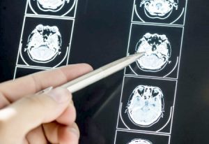 a doctor looking at an xray showing brain damage after a car accident