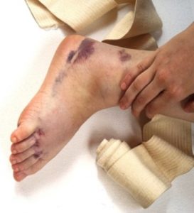 untreated ankle fracture.  untreated ankle fracture ankle injury compensation calculator average payout for ankle injury Medical negligence claim for a missed ankle fracture guide