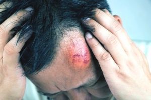 Man holding his head with a giant bruise caused by GBH