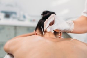 A person getting acupuncture performed on them