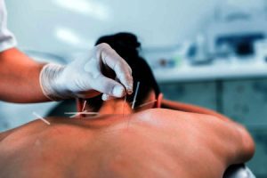 Dry needling negligence claims