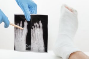 How to claim compensation for a hairline fracture guide