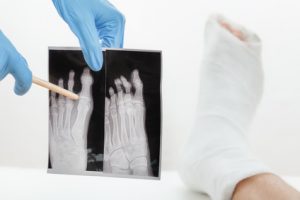 Doctor showing a hairline fracture x-ray to a patient after an operation