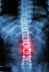 X-Ray showing a serious back injury