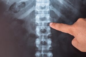 Man pointing to an x-ray of a serious spine injury