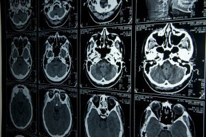 CT-Scan images showing different brain activity and levels of injury