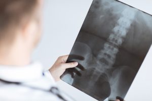 A doctor holding an X-ray scan image of someone's spine and pelvis.