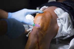 A medical professional inserting a needle with local anaesthetic into someone's knee.