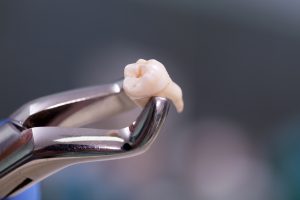 A dental practitioner removing an affected tooth with a pair of pliers during ongoing treatment